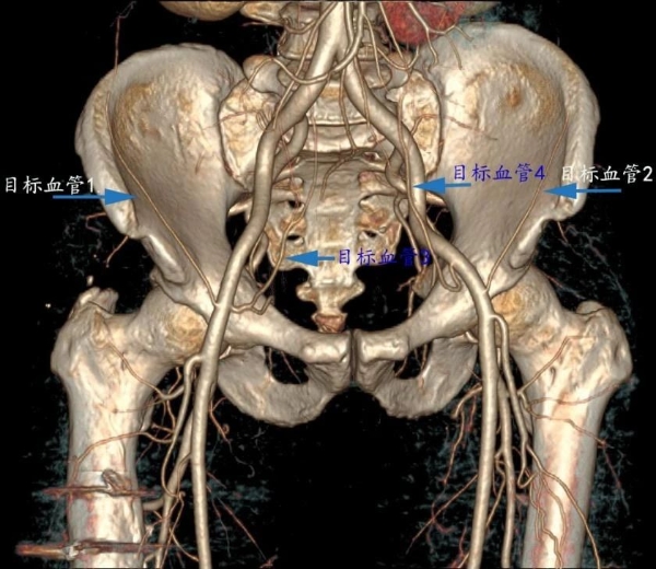 髂内动脉造影图谱图片